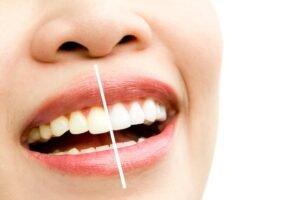 Best Teeth Whitening in Malviya Nagar