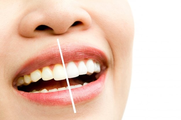Best Teeth Whitening in Malviya Nagar