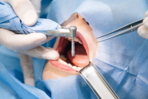Best oral surgery Centre in Malviya Nagar