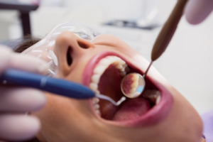 Best Dental Filling Services in Lajpat Nagar