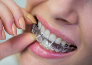 Best Teeth Aligners Treatment in South Delhi