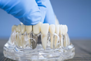 Best Crown and Bridge Services in Malviya Nagar