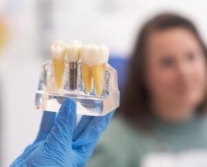 Best Dental Implant Centre in Lajpat Nagar