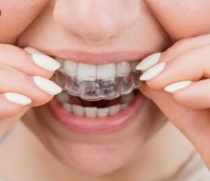 Best Teeth Aligners Service in Malviya Nagar