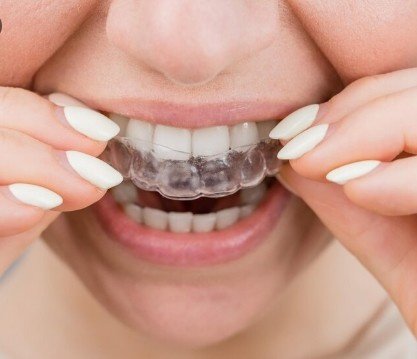 Best Teeth Aligners Service in Malviya Nagar