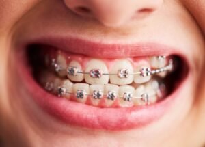 Best Braces For Teeth in Malviya Nagar Delhi